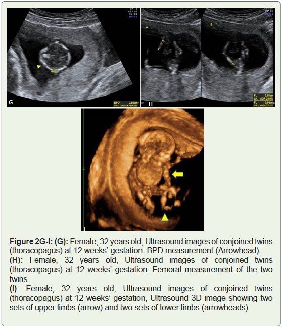 Cephalothoracopagus A Rare Congenital Anomaly